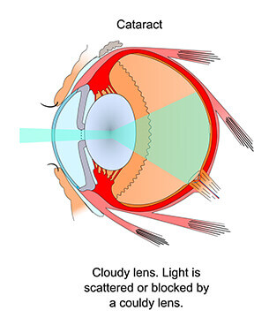 Diagram of Eye With Cataract