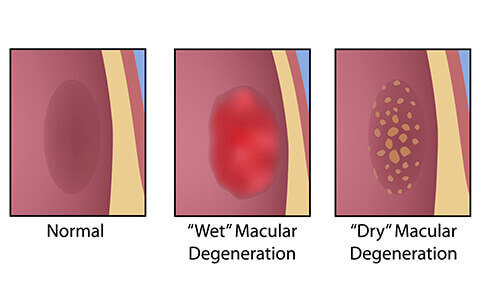 Macular Degeneration Diagram