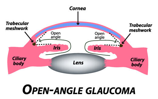 Open-Angle Glaucoma Diagram
